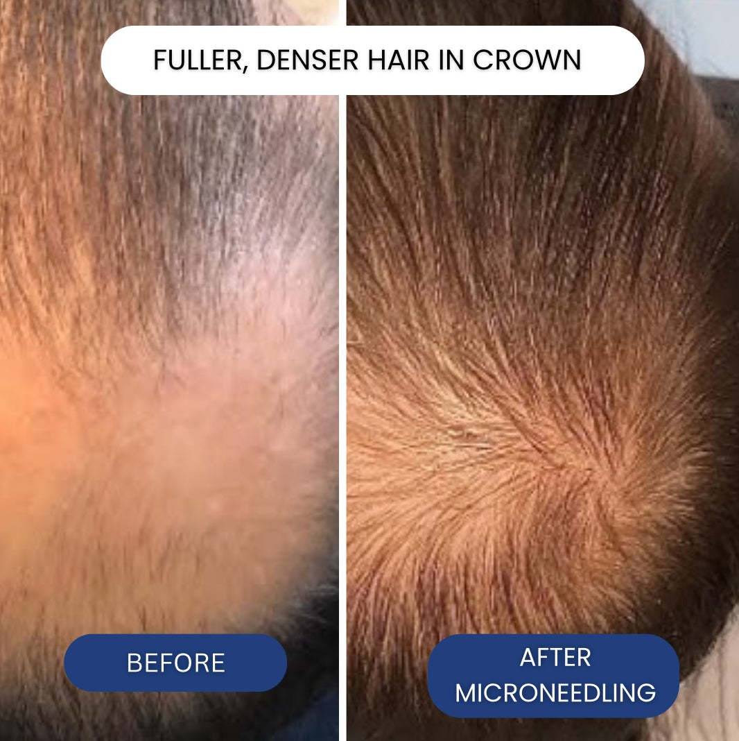 育毛マイクロニードリングGHK-Cuセラム（ブルーカッパーペ - Ingrown Hair Serum のレビューと価格