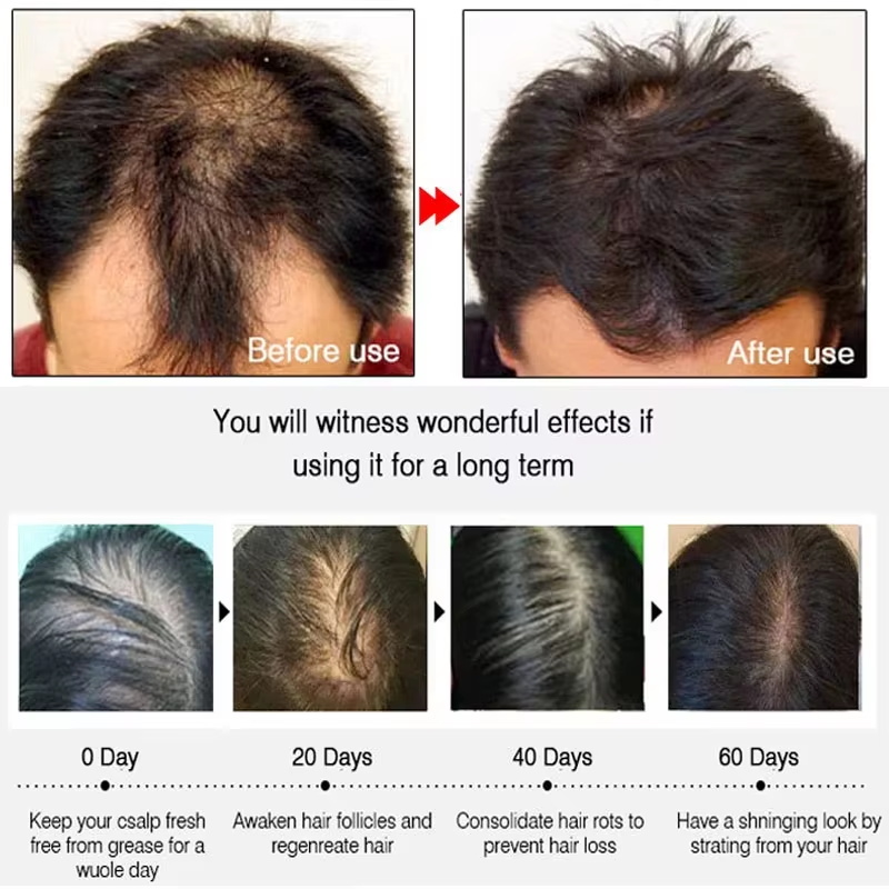 速効性ジンジャーヘアグローススプレー、毛根育成、脱毛防止、育 - Ingrown Hair Serum のレビューと価格